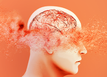 Acidente Vascular Cerebral